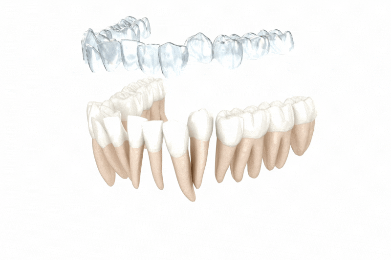 Aligner Video