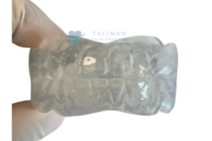 Aligner